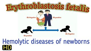 What is hemolytic diseases in newborns baby HDN  erythroblastosis fetalis in Hindi [upl. by Neve]