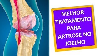 ARTROSE NO JOELHO TRATAMENTO DE FISIOTERAPIA Clínica Dr Robson Sitta [upl. by Poulter]